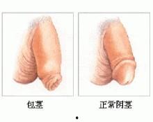 男人割包皮手术视频,专业视角下的真实记录