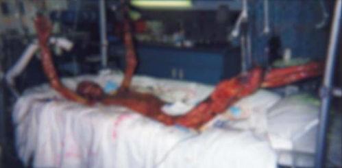 日本被核辐射人照片,日本核辐射受害者真实写照